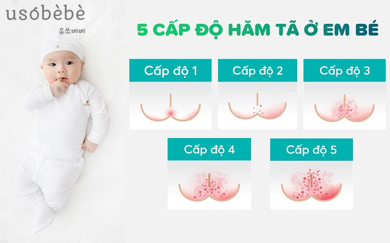 Các mức độ hăm da ở bé sơ sinh cha mẹ nên biết