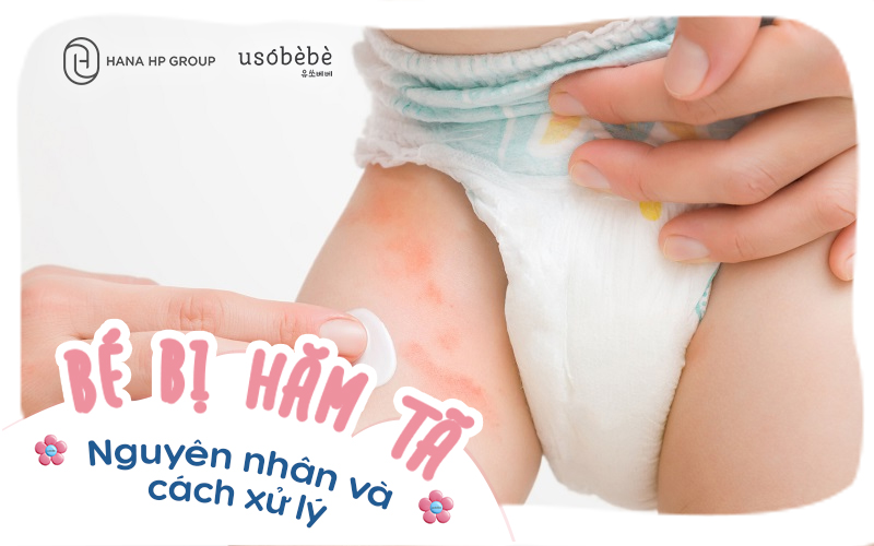 Bé Bị Hăm Tã: Nguyên Nhân, Cách Xử lý & phòng ngừa hiệu quả