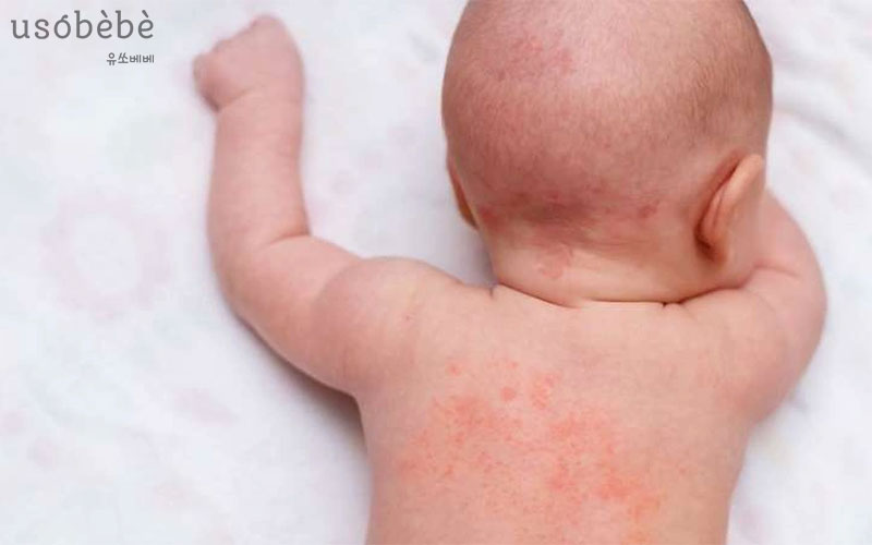 Rôm sảy là bệnh ngoài ra thường gặp ở bé vào thời tiết nắng nóng Rôm sảy là bệnh ngoài ra thường gặp ở bé vào thời tiết nắng nóng