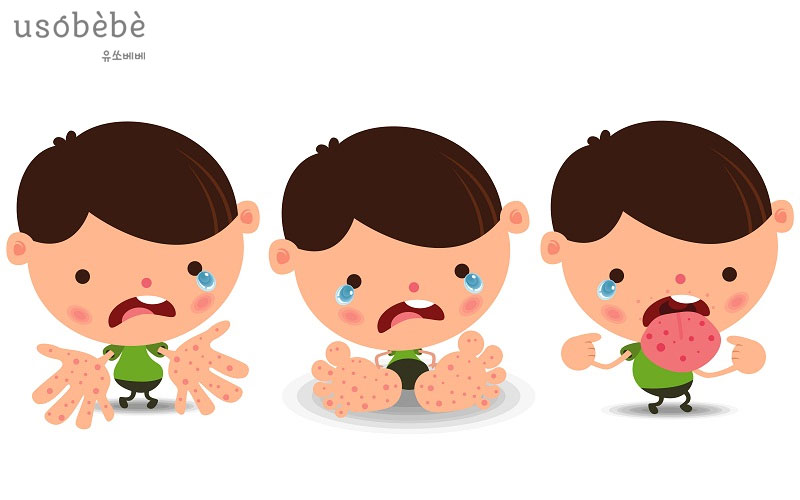 Tay chân miệng là một trong những bệnh truyền nhiễm mùa hè thường gặp Tay chân miệng là một trong những bệnh truyền nhiễm mùa hè thường gặp