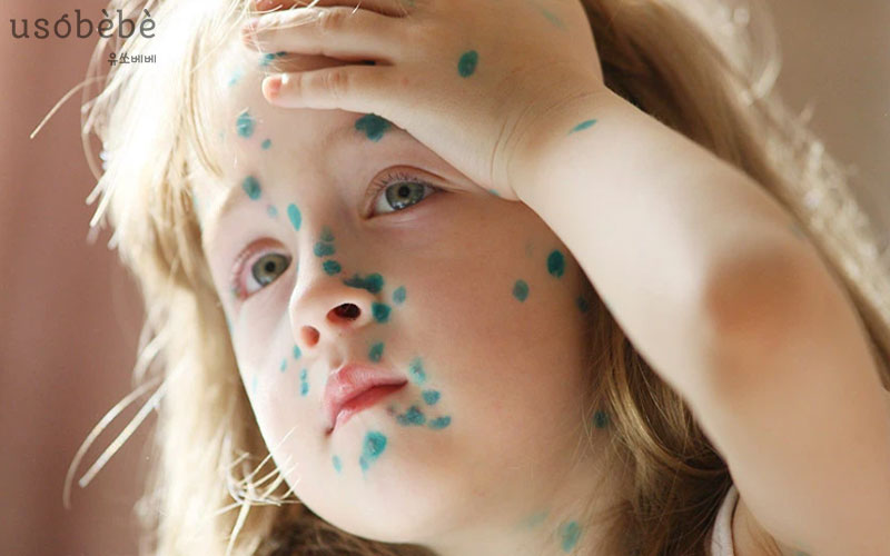 Thủy đậu dễ bùng phát vào thời điểm giao mùa xuân hè Thủy đậu dễ bùng phát vào thời điểm giao mùa xuân hè