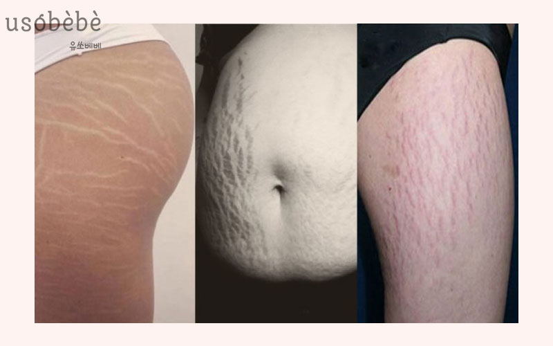 Những vị trí thường xuất hiện vết rạn da bao gồm mông, bụng và đùi Những vị trí thường xuất hiện vết rạn da bao gồm mông, bụng và đùi