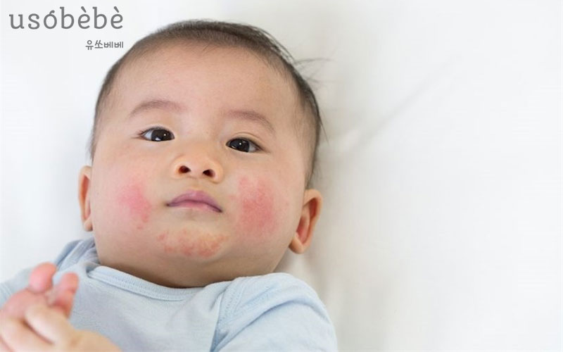 Chàm Sữa (Viêm da cơ địa ở trẻ)