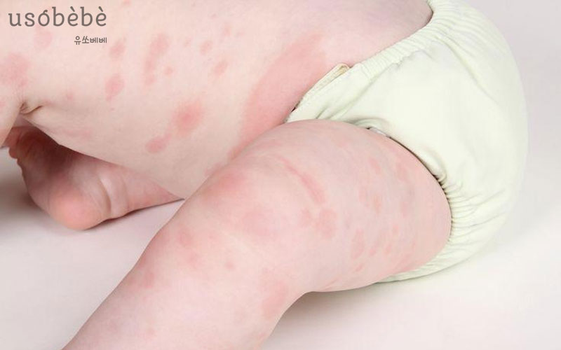 Dấu hiệu bé bị dị ứng sữa tắm Dấu hiệu bé bị dị ứng sữa tắm
