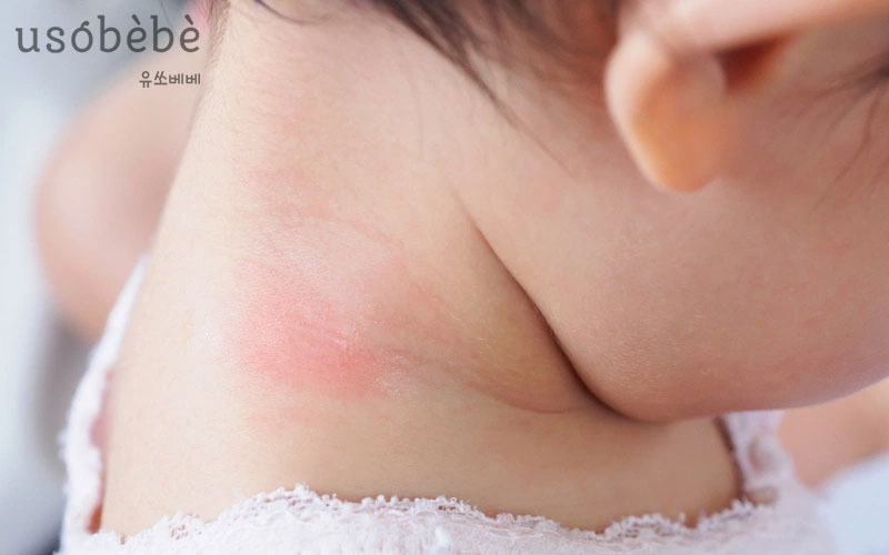 Những dấu hiệu dễ nhận biết khi bé bị hăm cổ