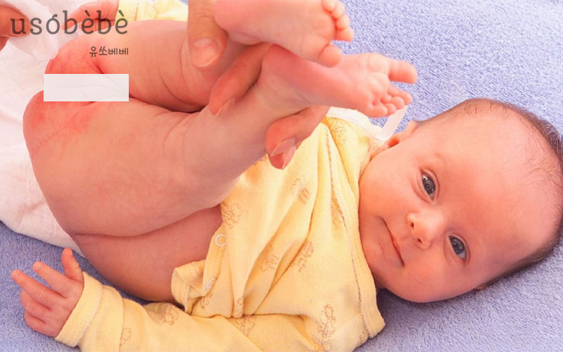 Dấu hiệu nhận biết hăm da vùng kín ở bé trai và bé gái