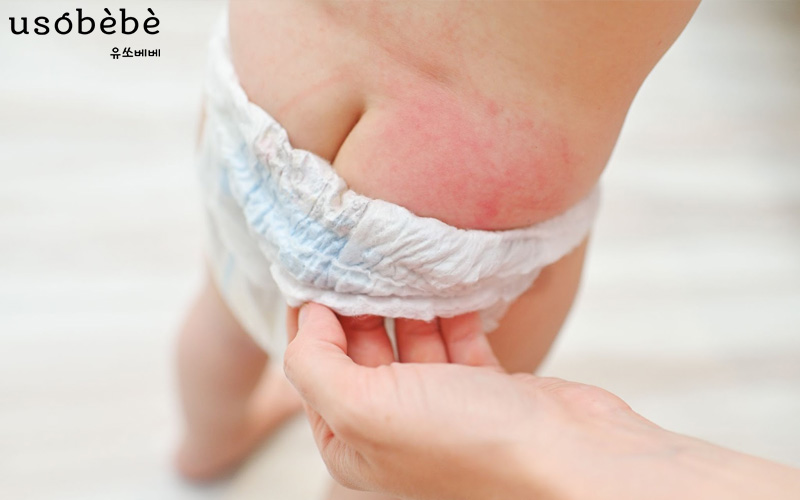 Thời tiết hanh khô khiến da trẻ bị nứt nẻ, khô ráp và dễ bị hăm tã