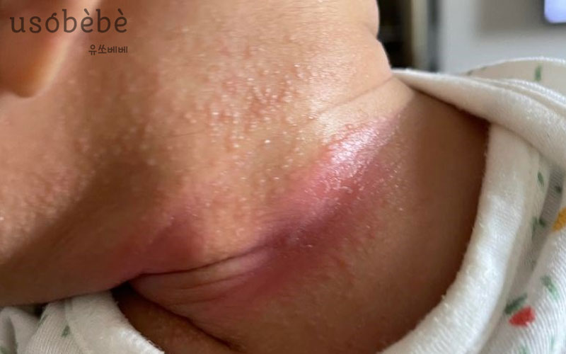 Nếu hăm cổ ở bé có dấu hiệu nặng cần phải đến Bác Sĩ để khám chữa