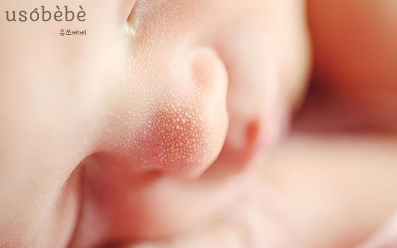 Mụn Sữa (mụn hạt kê) ở trẻ sơ sinh