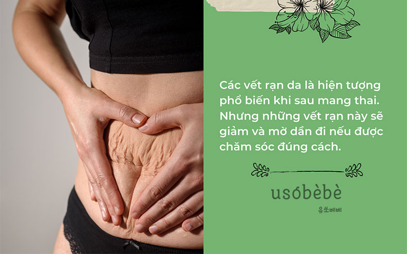 Các vết rạn da là hiện tượng phổ biến nhất sau khi mang thai Các vết rạn da là hiện tượng phổ biến nhất sau khi mang thai