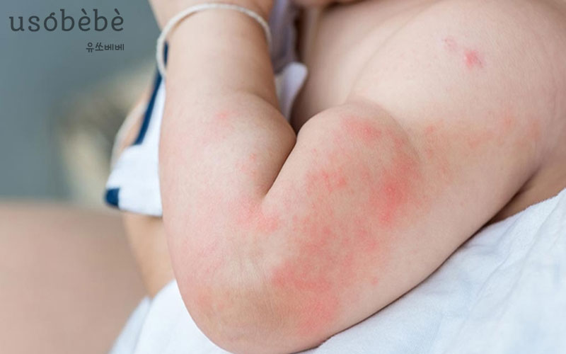 Nổi mề đay là bệnh ngoài da khá phổ biến ở trẻ sơ sinh
