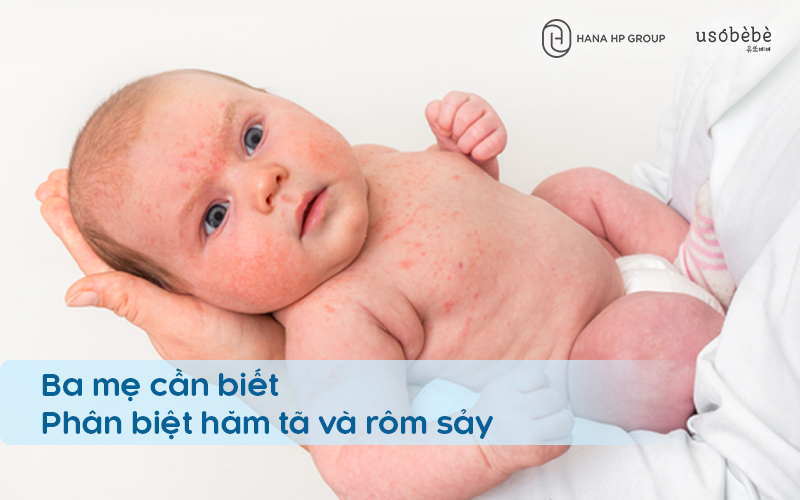 Phân biệt hăm tã và rôm sảy ở trẻ như thế nào? Điều trị ra sao?