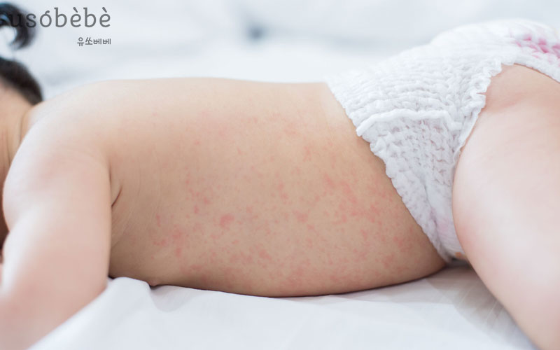 Rôm sảy ở trẻ em