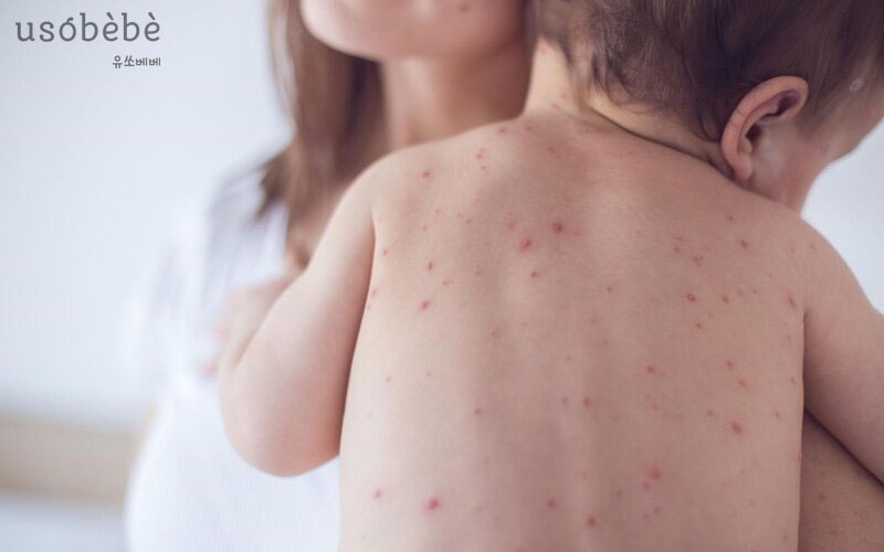 Sốt virus là bệnh thường xuyên gặp ở trẻ vào những ngày hè nắng nóng Sốt virus là bệnh thường xuyên gặp ở trẻ vào những ngày hè nắng nóng