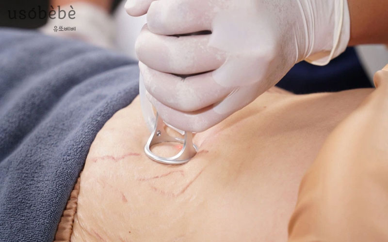 Điều trị rạn da sau khi sinh bằng phương pháp laser
