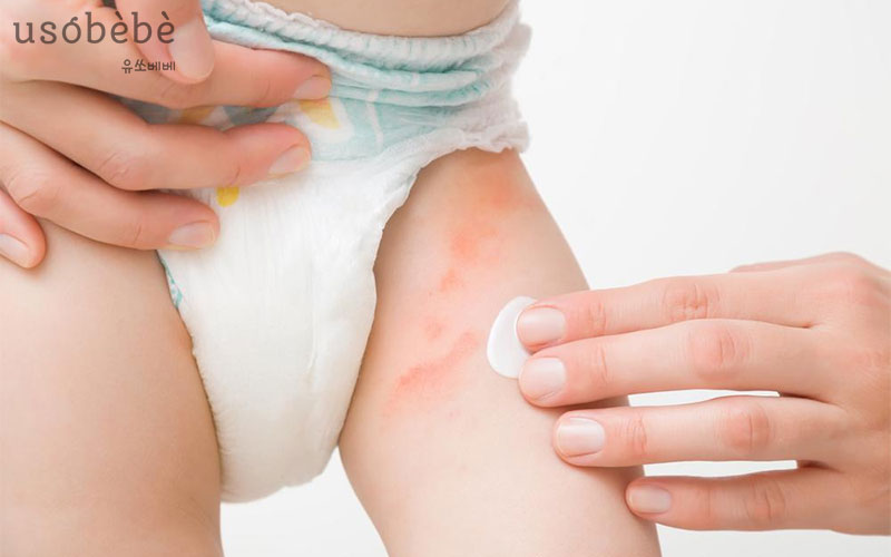 Xuất hiện những nốt nhỏ liti và to dần ở vùng mặc tã